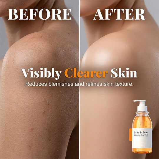 🔥 50% OFF TODAY! 🛁 Anti-Mite &amp; Acne Control Body Wash ✨ Deep Cleansing, Oil Control &amp; Clearer-Looking Skin