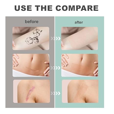 Tattoo cover-up tape, 2" x 16.4&
