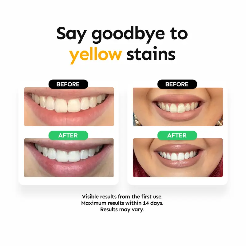 🔥Limited-Time Special Offer！🦷 Professional Non-Peroxide Teeth Whitening ✨ Whiter Smile, Zero Sensitivity &amp; Gentle Everyday Care 💎