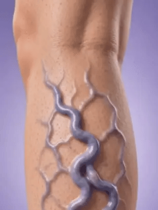 Herbal Varicose Vein Treatment Cream
